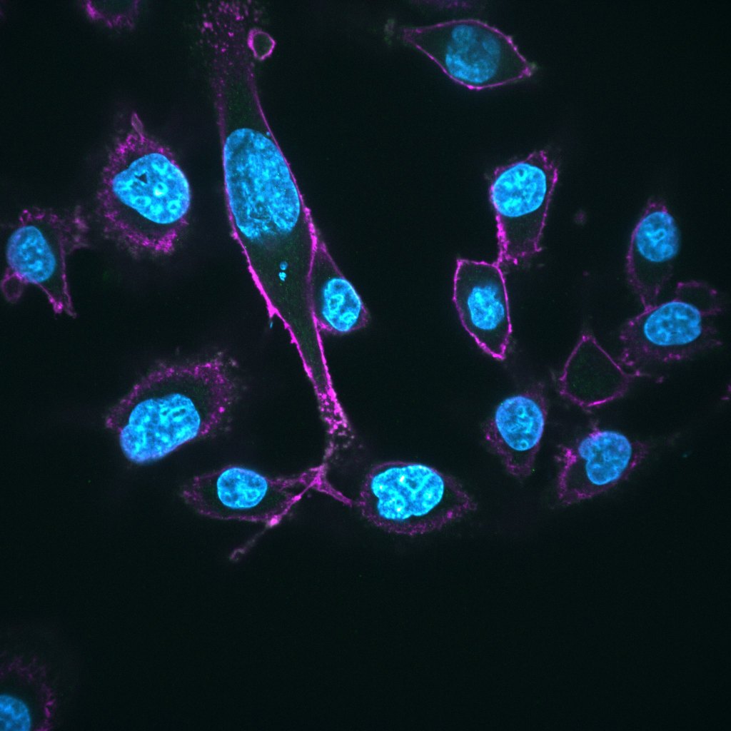 ATR Expression in Pancreatic Cancer
